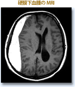 説明画像：硬幕下血種のMRI