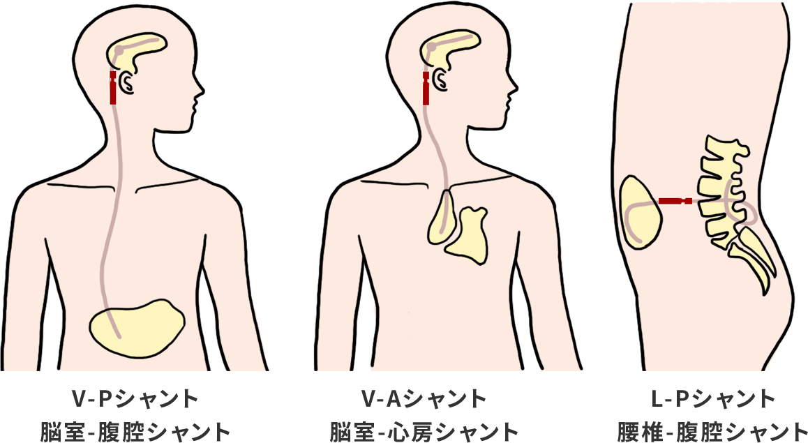 脳室－腹腔シャント、脳室－心房シャント、腰椎－腹腔シャント