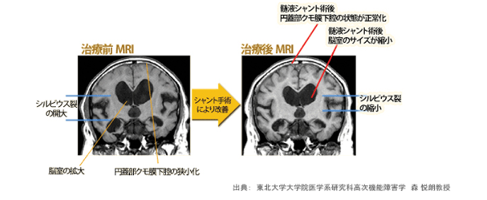 シャント手術前、シャント手術後MRI